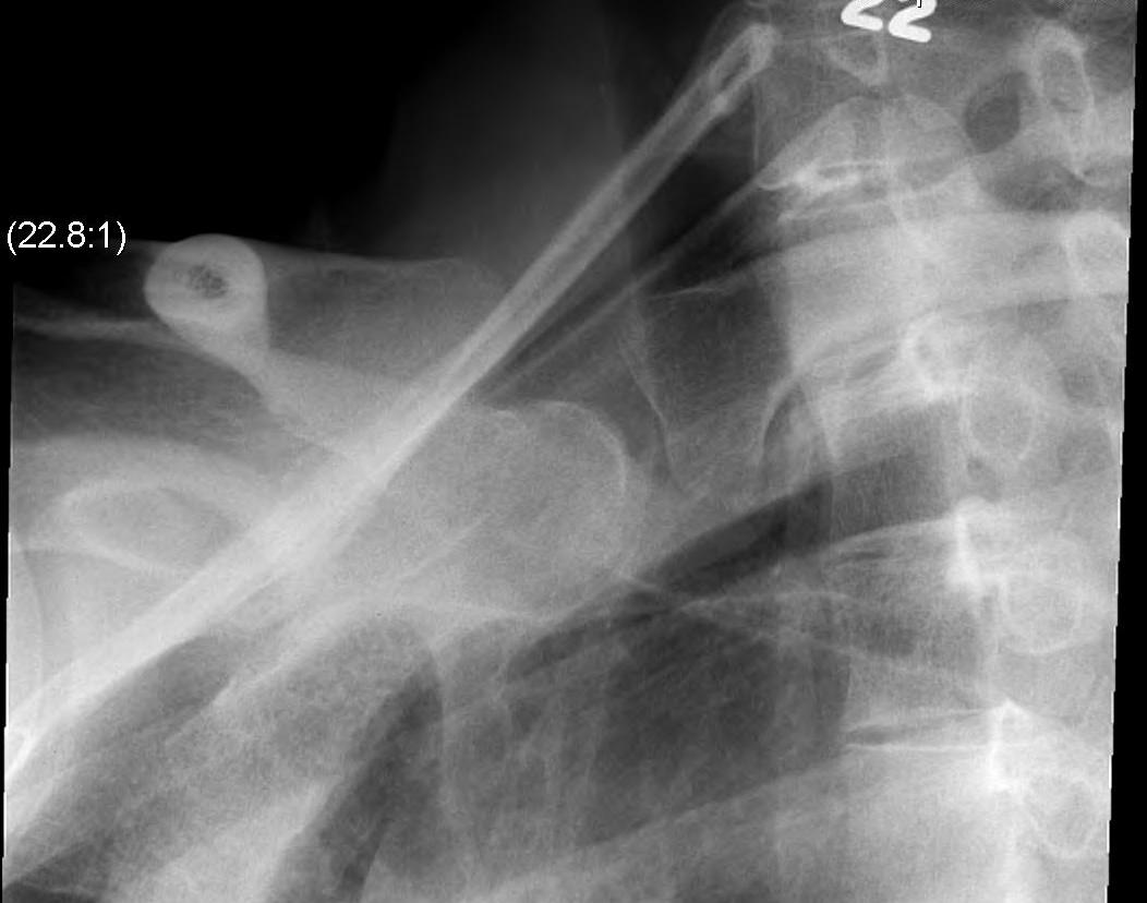 Sternoclavicular Joint Xrays 2